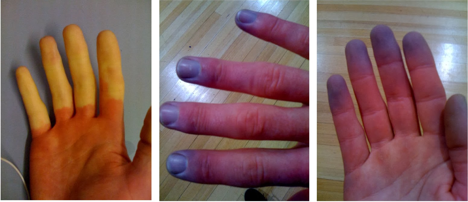 What are symptoms of Raynaud's disease?